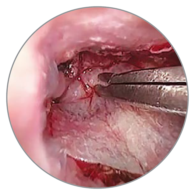 Platzierung des Biodesign® Otologic Repair Graft Implantats Platzierung des Biodesign® Otologic Repair Graft Implantats