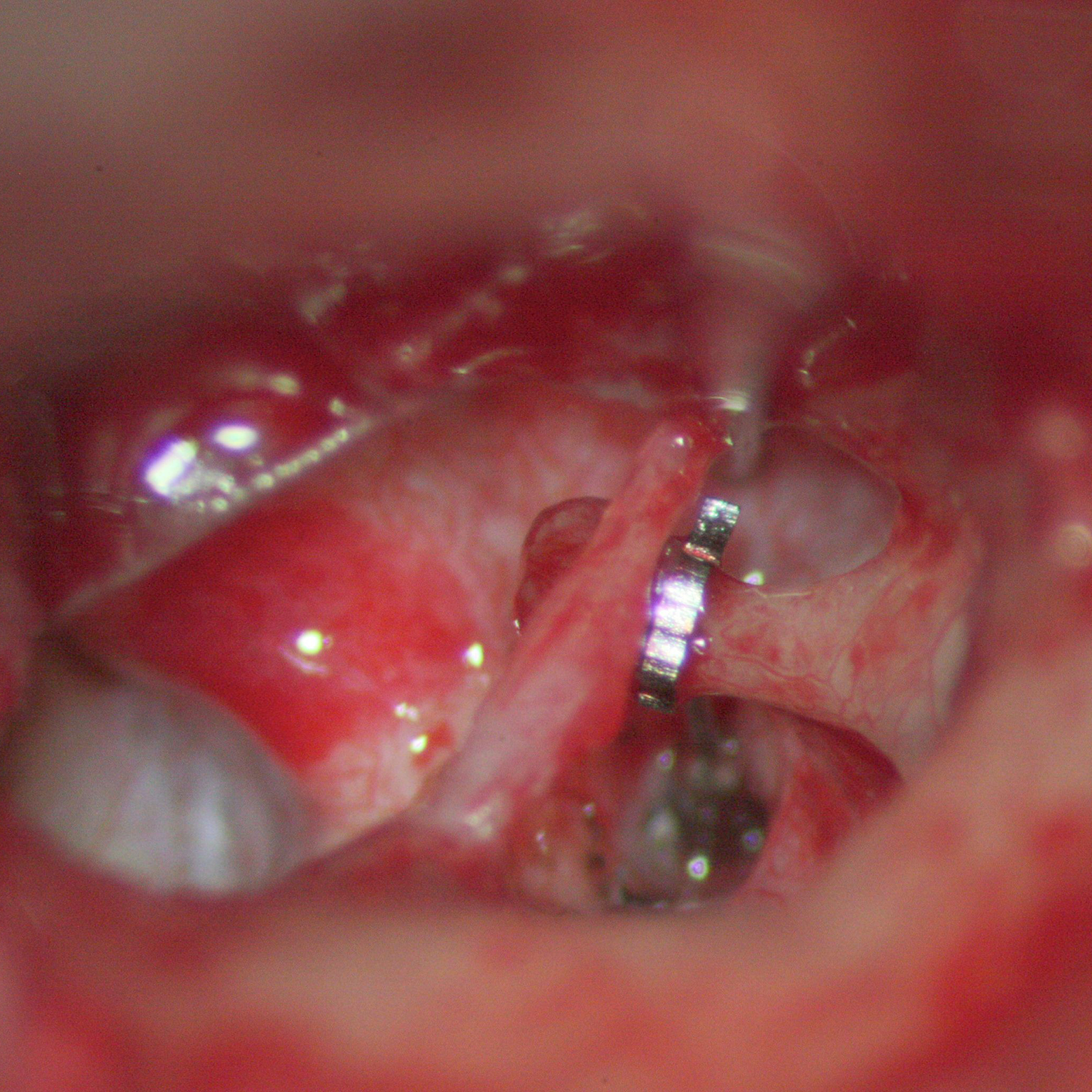 NiTiBOND® in-situ